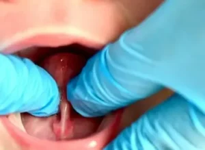 Sesión diagnóstico o rehabilitación Frenillo sublingual (1h)